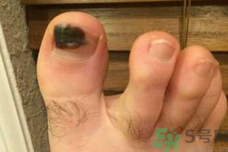 腳趾甲變黑是什么原因？腳趾甲變黑是怎么回事？