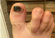 腳趾甲變黑是什么原因？腳趾甲變黑是怎么回事？