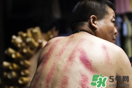 背部刮痧后能拔火罐嗎？背部刮痧后拔火罐有什么好處？