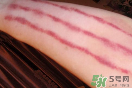 揪痧和刮痧哪個效果比較好？揪痧和刮痧的區(qū)別？