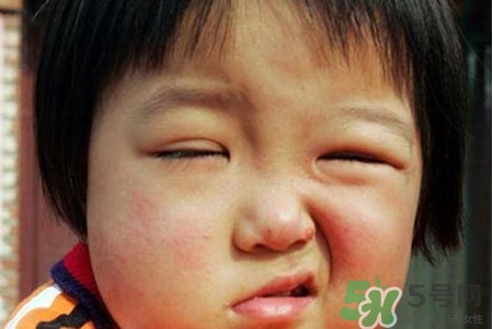 面癱能針灸嗎？針灸能治療面癱嗎？