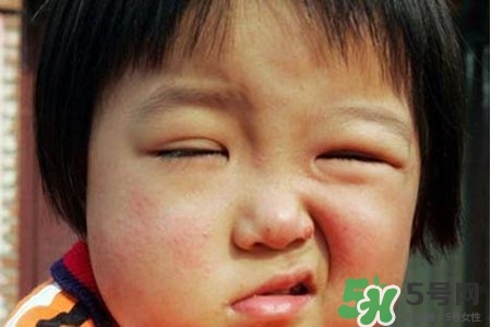 拔牙會導(dǎo)致面癱嗎?？拔牙為什么會導(dǎo)致面癱？