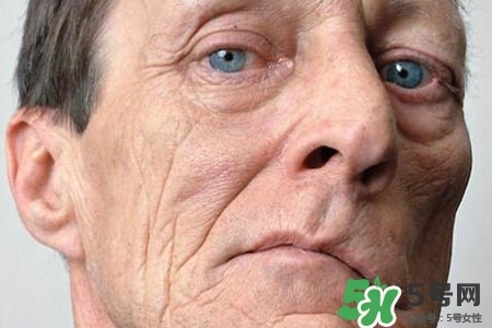 老年人為什么容易得面癱？老年人面癱原因有哪些？