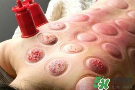 拔罐放血對身體好嗎？拔罐放血有什么好處？