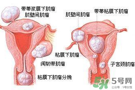 子宮小會影響生育嗎？子宮小會導(dǎo)致不孕嗎？