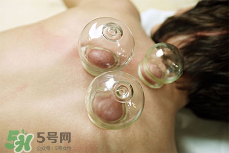 冬天拔罐好嗎？冬季最好不要拔火罐