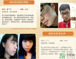 芷軒堂祛痘有效果嗎？芷軒堂祛痘印效果怎么樣？