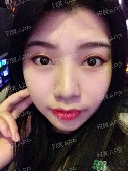 切開雙眼皮消腫過(guò)程圖_切開雙眼皮恢復(fù)過(guò)程圖