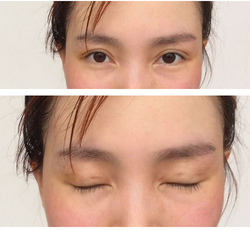 三點雙眼皮恢復(fù)過程圖_韓式三點雙眼皮多久恢復(fù)自然 三點雙眼皮恢復(fù)過程圖_韓式三點雙眼皮多久恢復(fù)自然