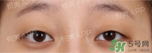 埋線雙眼皮多久恢復(fù)自然？埋線雙眼皮多久能恢復(fù)