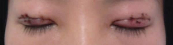 三點雙眼皮恢復(fù)過程圖_韓式三點雙眼皮多久恢復(fù)自然 三點雙眼皮恢復(fù)過程圖_韓式三點雙眼皮多久恢復(fù)自然