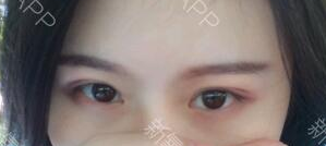 定點(diǎn)雙眼皮能保持多久？定點(diǎn)雙眼皮是永久的嗎？
