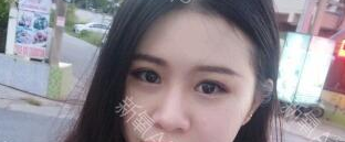 定點(diǎn)雙眼皮能保持多久？定點(diǎn)雙眼皮是永久的嗎？
