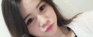 定點(diǎn)雙眼皮能保持多久？定點(diǎn)雙眼皮是永久的嗎？