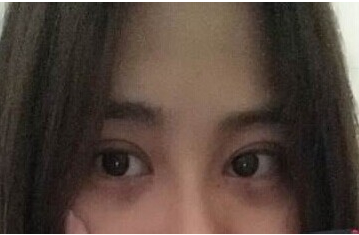 定點雙眼皮怎么做？定點雙眼皮需要拆線嗎？