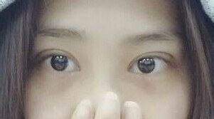 定點雙眼皮怎么做？定點雙眼皮需要拆線嗎？