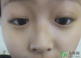 埋線雙眼皮需要拆線嗎？埋線雙眼皮怎么拆線