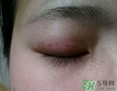 埋線雙眼皮需要拆線嗎？埋線雙眼皮怎么拆線