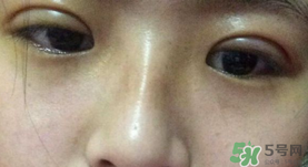 埋線雙眼皮需要拆線嗎？埋線雙眼皮怎么拆線