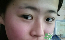 埋線雙眼皮需要拆線嗎？埋線雙眼皮怎么拆線