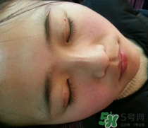 埋線雙眼皮需要拆線嗎？埋線雙眼皮怎么拆線