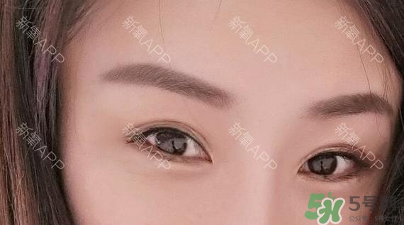 埋線雙眼皮能保持多久？埋線雙眼皮是永久嗎