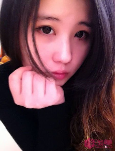 三點雙眼皮恢復(fù)過程圖_韓式三點雙眼皮多久恢復(fù)自然 三點雙眼皮恢復(fù)過程圖_韓式三點雙眼皮多久恢復(fù)自然