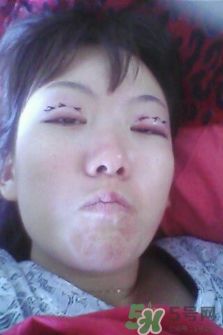 什么是定點(diǎn)雙眼皮？定點(diǎn)雙眼皮多少錢？