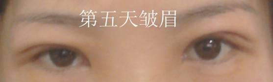 三點雙眼皮恢復(fù)過程圖_韓式三點雙眼皮多久恢復(fù)自然 三點雙眼皮恢復(fù)過程圖_韓式三點雙眼皮多久恢復(fù)自然