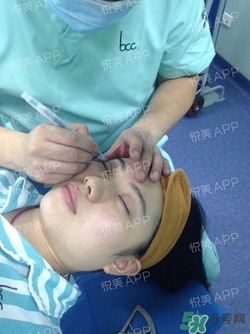 切開雙眼皮消腫過(guò)程圖_切開雙眼皮恢復(fù)過(guò)程圖