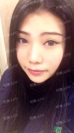 切開雙眼皮消腫過(guò)程圖_切開雙眼皮恢復(fù)過(guò)程圖