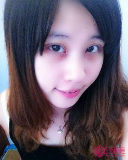 三點雙眼皮恢復(fù)過程圖_韓式三點雙眼皮多久恢復(fù)自然 三點雙眼皮恢復(fù)過程圖_韓式三點雙眼皮多久恢復(fù)自然