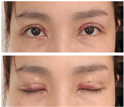 三點雙眼皮恢復(fù)過程圖_韓式三點雙眼皮多久恢復(fù)自然 三點雙眼皮恢復(fù)過程圖_韓式三點雙眼皮多久恢復(fù)自然