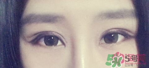 切開(kāi)雙眼皮多久消腫？切開(kāi)雙眼皮多久恢復(fù)？