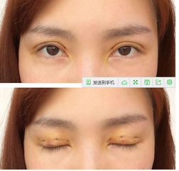 三點雙眼皮恢復(fù)過程圖_韓式三點雙眼皮多久恢復(fù)自然 三點雙眼皮恢復(fù)過程圖_韓式三點雙眼皮多久恢復(fù)自然