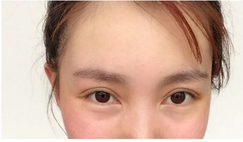 三點雙眼皮恢復(fù)過程圖_韓式三點雙眼皮多久恢復(fù)自然 三點雙眼皮恢復(fù)過程圖_韓式三點雙眼皮多久恢復(fù)自然
