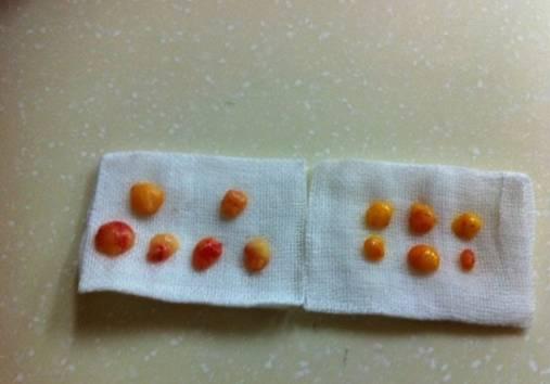 韓式三點雙眼皮是永久嗎？三點雙眼皮能保持多久？