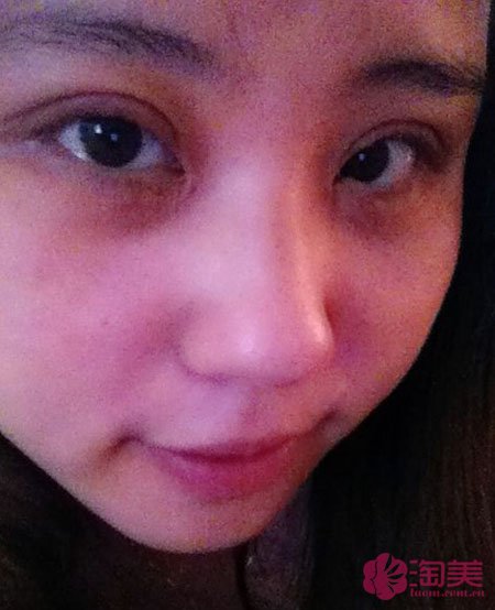 三點雙眼皮恢復(fù)過程圖_韓式三點雙眼皮多久恢復(fù)自然 三點雙眼皮恢復(fù)過程圖_韓式三點雙眼皮多久恢復(fù)自然