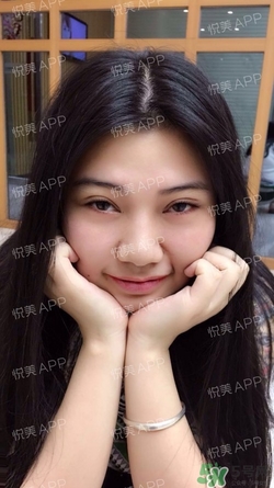 切開雙眼皮消腫過(guò)程圖_切開雙眼皮恢復(fù)過(guò)程圖