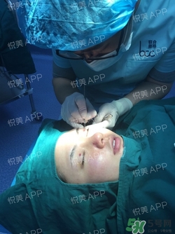 定點雙眼皮恢復(fù)過程圖_定點雙眼皮要多久恢復(fù) 定點雙眼皮恢復(fù)過程圖_定點雙眼皮要多久恢復(fù)