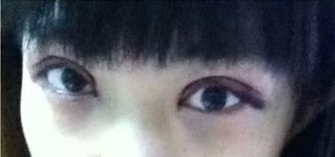 韓式三點雙眼皮是永久嗎？三點雙眼皮能保持多久？