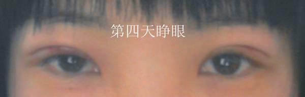 三點雙眼皮恢復(fù)過程圖_韓式三點雙眼皮多久恢復(fù)自然 三點雙眼皮恢復(fù)過程圖_韓式三點雙眼皮多久恢復(fù)自然