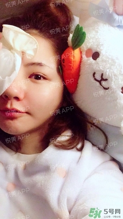 定點雙眼皮恢復(fù)過程圖_定點雙眼皮要多久恢復(fù) 定點雙眼皮恢復(fù)過程圖_定點雙眼皮要多久恢復(fù)