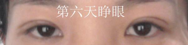 三點雙眼皮恢復(fù)過程圖_韓式三點雙眼皮多久恢復(fù)自然 三點雙眼皮恢復(fù)過程圖_韓式三點雙眼皮多久恢復(fù)自然