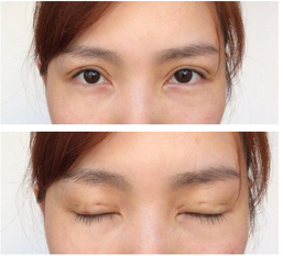 三點雙眼皮恢復(fù)過程圖_韓式三點雙眼皮多久恢復(fù)自然 三點雙眼皮恢復(fù)過程圖_韓式三點雙眼皮多久恢復(fù)自然