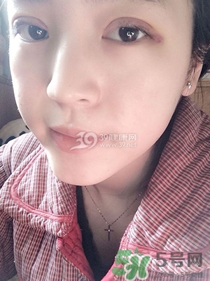 什么是定點(diǎn)雙眼皮？定點(diǎn)雙眼皮多少錢？
