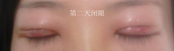 三點雙眼皮恢復(fù)過程圖_韓式三點雙眼皮多久恢復(fù)自然 三點雙眼皮恢復(fù)過程圖_韓式三點雙眼皮多久恢復(fù)自然