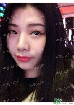 切開雙眼皮消腫過(guò)程圖_切開雙眼皮恢復(fù)過(guò)程圖