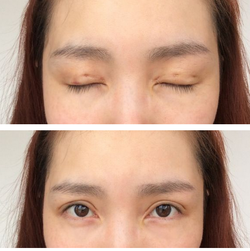 三點雙眼皮恢復(fù)過程圖_韓式三點雙眼皮多久恢復(fù)自然 三點雙眼皮恢復(fù)過程圖_韓式三點雙眼皮多久恢復(fù)自然