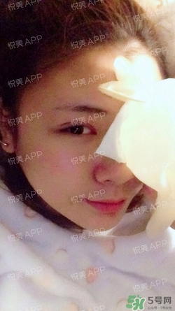 定點雙眼皮恢復(fù)過程圖_定點雙眼皮要多久恢復(fù) 定點雙眼皮恢復(fù)過程圖_定點雙眼皮要多久恢復(fù)